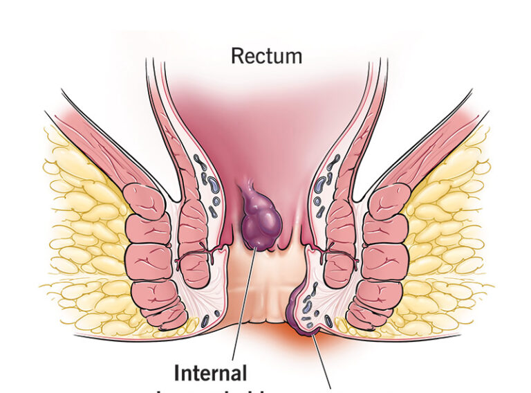 15120-hemorrhoids