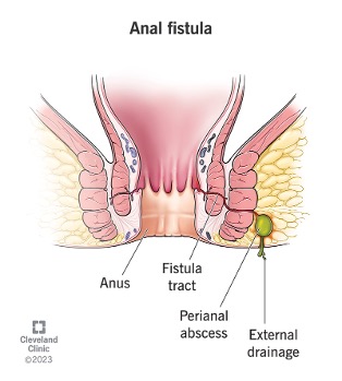 ana-fistula