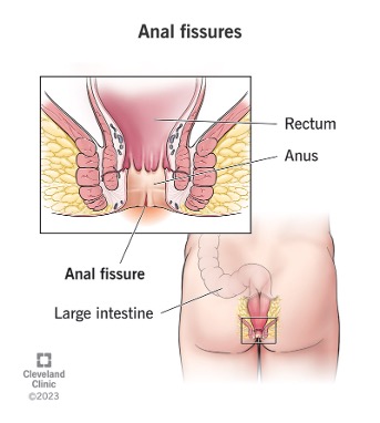 analna-fisura
