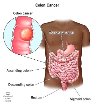 colon-cancer