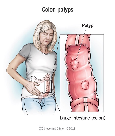 colon-polyps