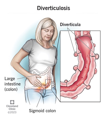 diverticulosa
