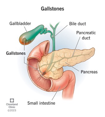 gallstones