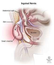 inguinal hernia