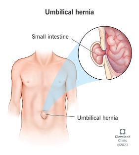 pupna-hernia