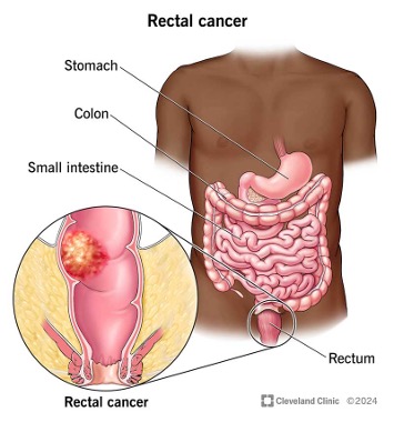 recatal-cancer