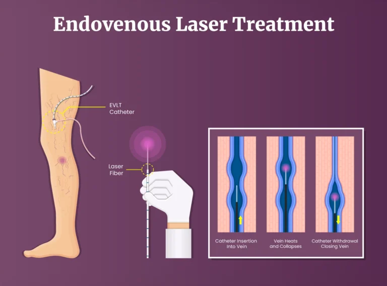 Endovenous-Laser-Ablation 2 Endovenous-Laser-Ablation 2