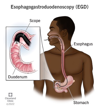 egd