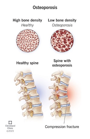 osteopozora