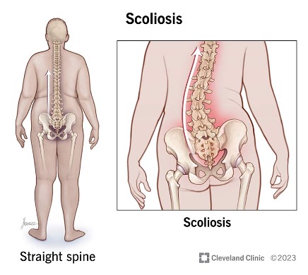 skolioza